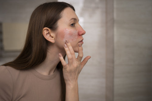 How To Combat Skin Redness and Irritation Naturally